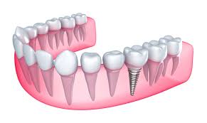 Как происходит имплантация зуба